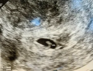 O que dá para ver no ultrassom de 5 semanas